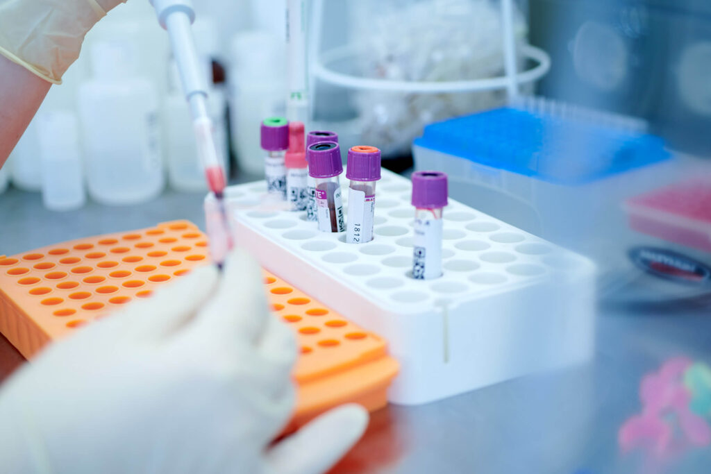 Hämochromatoserisiko – Laboranalyse der HFE-Genmutationen